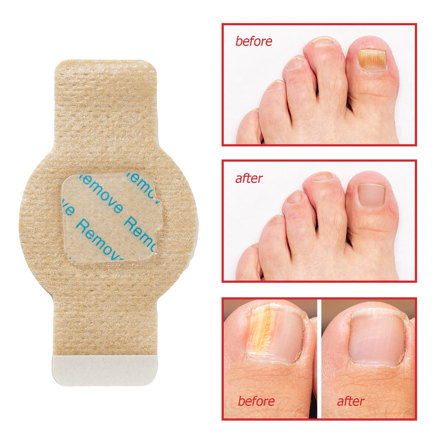 💅 Extra Strength Nail Fungus Treatment Patches | 21 Pack