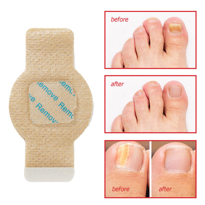 💅 Extra Strength Nail Fungus Treatment Patches | 21 Pack