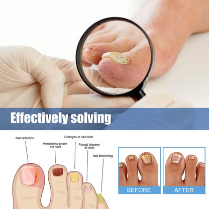 💅 Extra Strength Nail Fungus Treatment Patches | 21 Pack